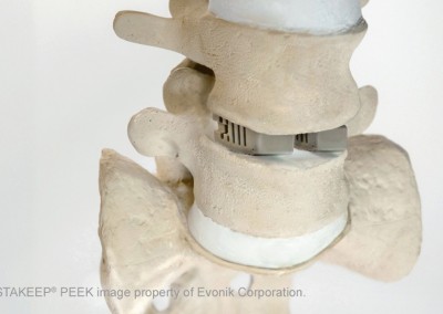 Evonik-VESTAKEEP-PEEK-Spinal-spacers-in-spine-model
